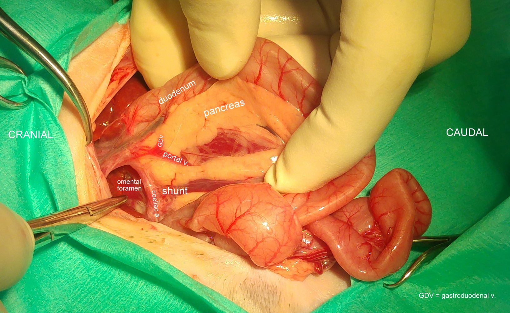 shunt-and-pv-r-side-view-at-surgery