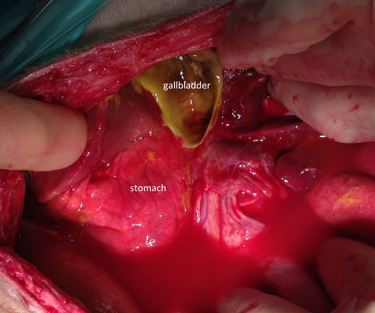 gallbladder-rupture-at-surgery