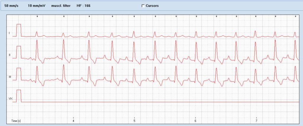 Paroxysmal supraventricular tachycardia in an old Bouvier – Vet ...