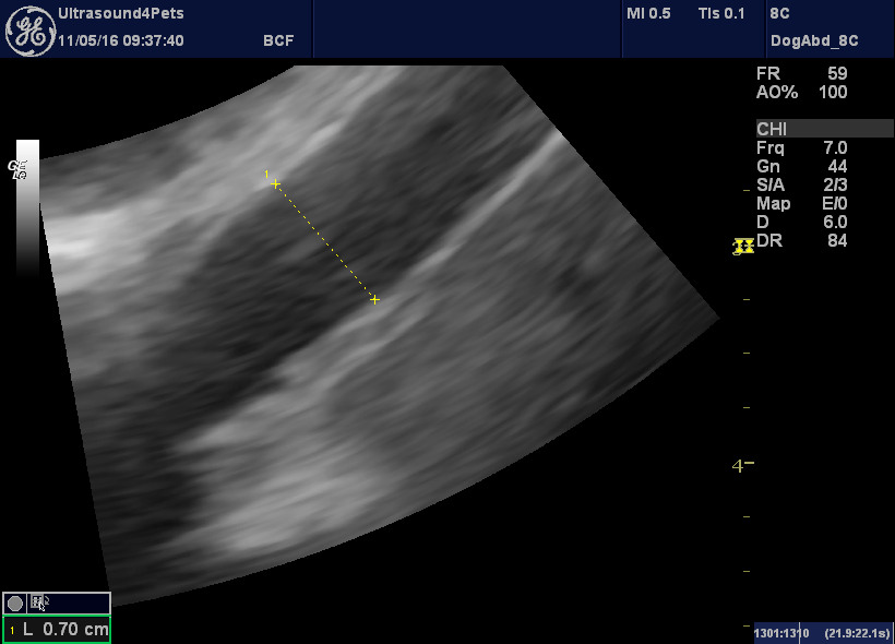 Congenital extrahepatic portosystemic shunt via the right gastric vein