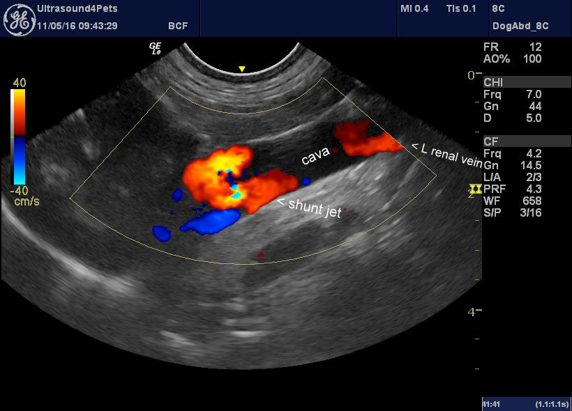 Congenital extrahepatic portosystemic shunt via the right gastric vein