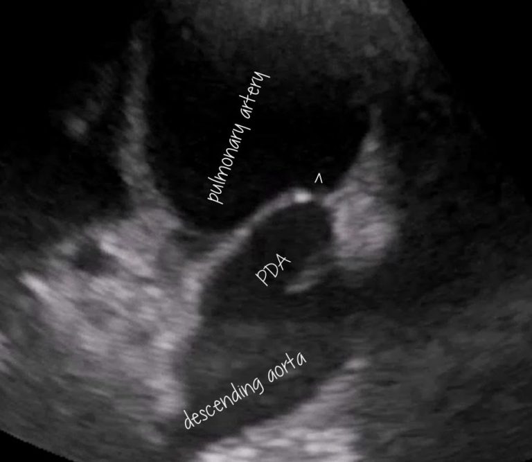 Canine patent ductus arteriosus (PDA) echocardiography Vet Practice